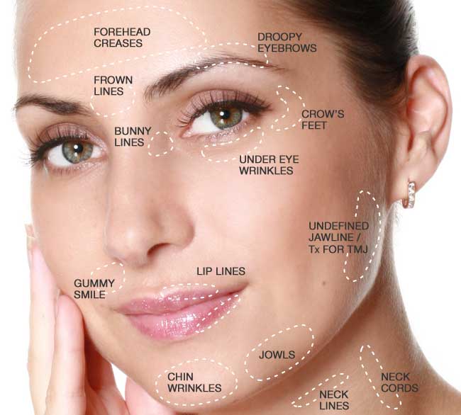 Infographic of Botox injectable areas Botox Palm Springs