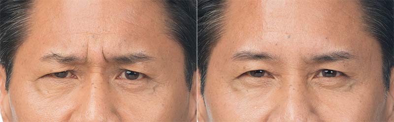 Botox Before and After Photos